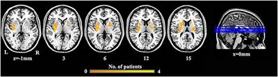 Alterations of Functional Connectivity in Stroke Patients With Basal Ganglia Damage and Cognitive Impairment